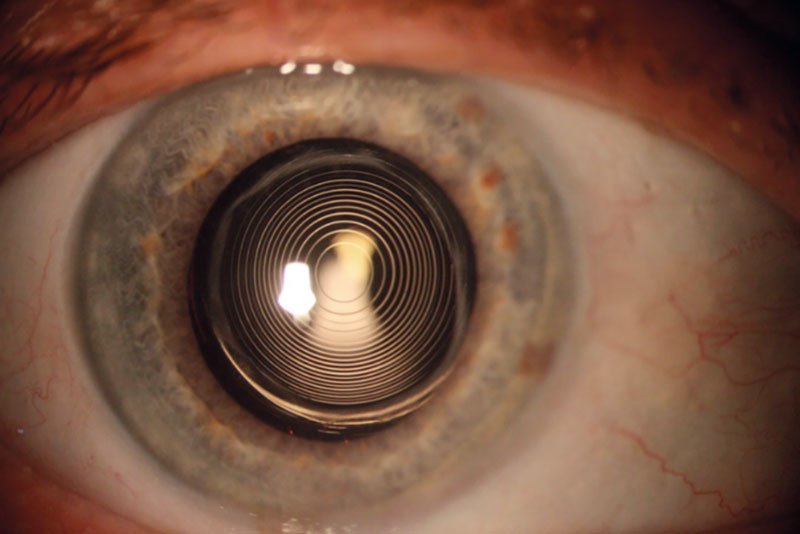 Multifokale Intraokularlinse im Auge