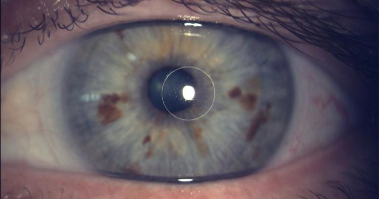 Linkes Auge mit temporal zur Pupille dezentrierter Zentralzone.