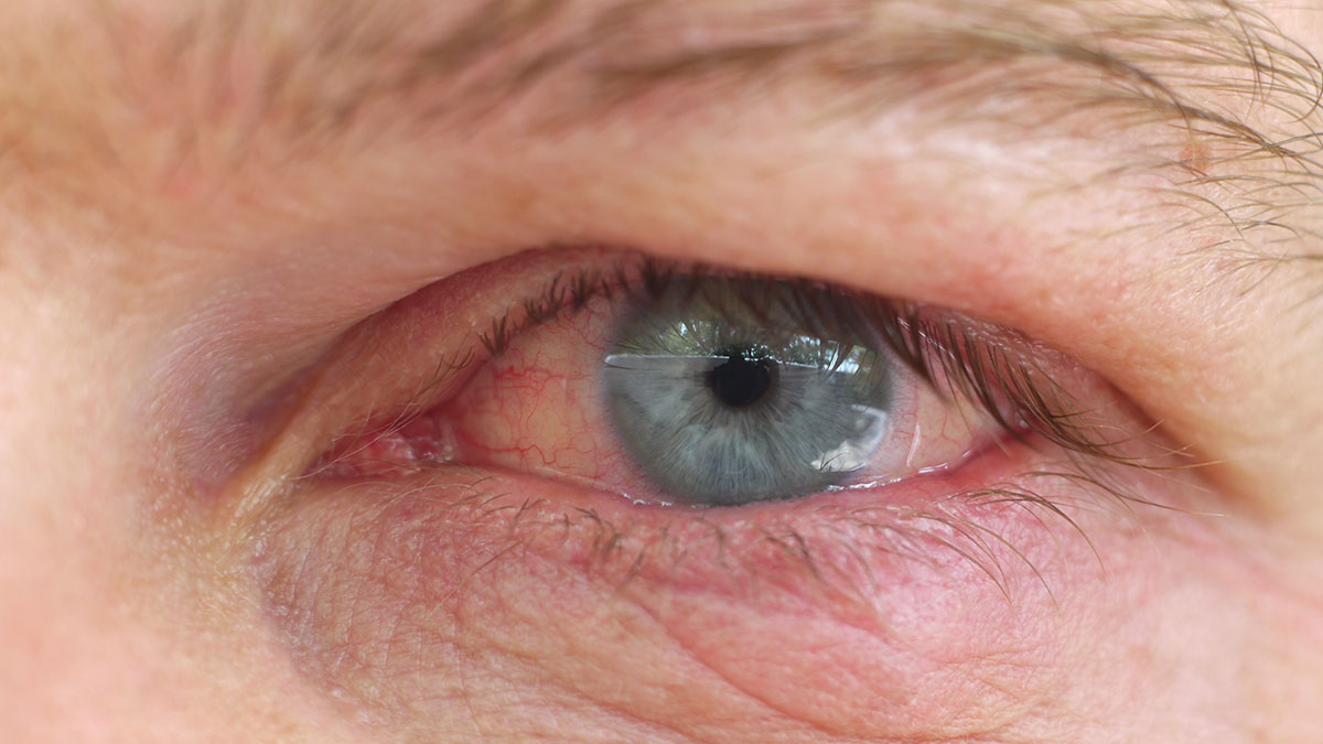 gerötetes Auge mit weicher Kontaktlinse