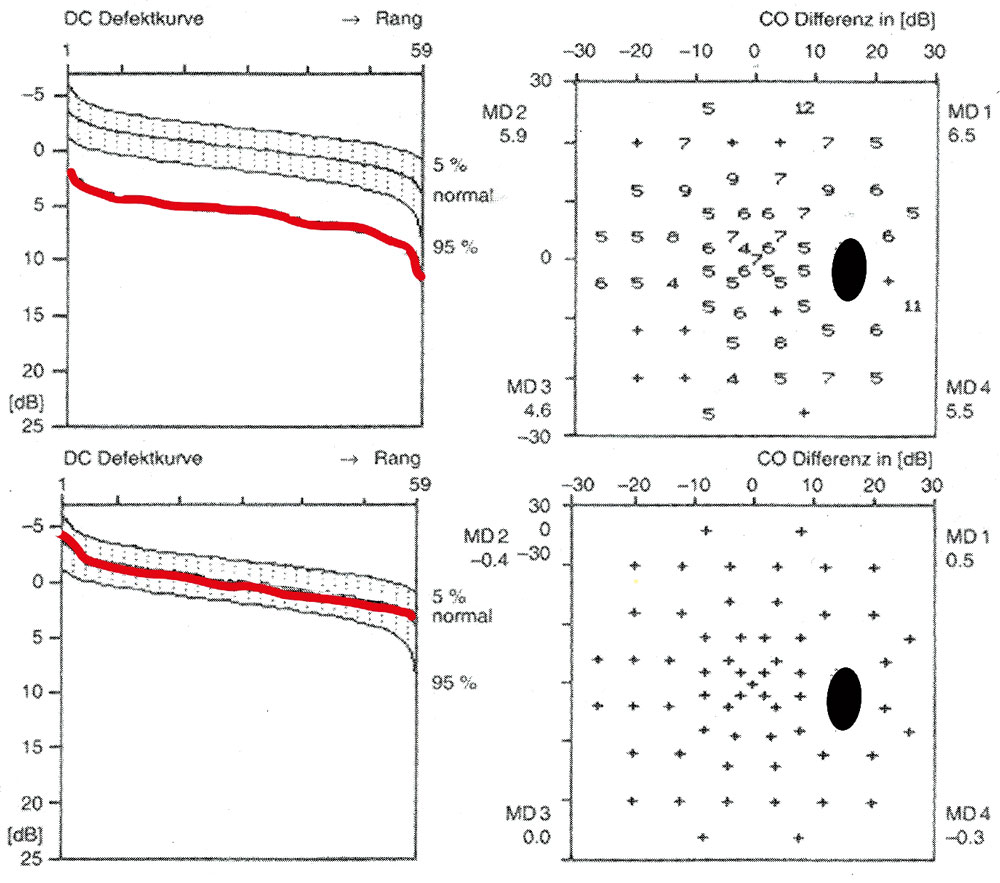 Gesichtsfeld bei unkorrigierter Myopie von -3 dpt