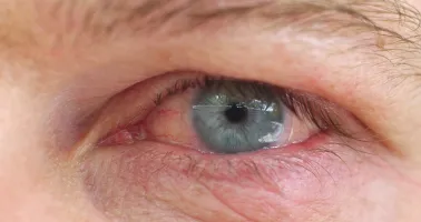 gereiztes Auge