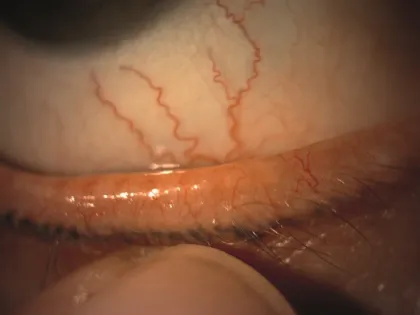 Bild von erweiterten, feinen Blutgefäßen am Lidrand eines Auges