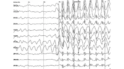 Aufnahme von Nervenzellen des Gehirns