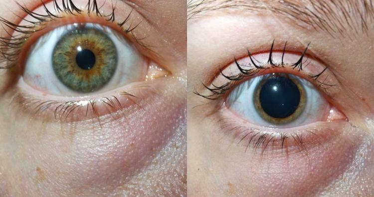 Augen links Abdruck einer Gonioskopie-Linse, rechts Auge mit weitgetropfter Pupille